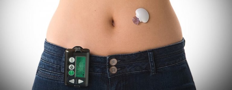 artificial pancreas