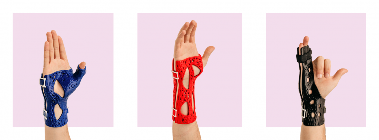 Examples of 3D-Printed casts