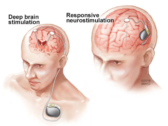 Deep brain simulation in epilepsy patients